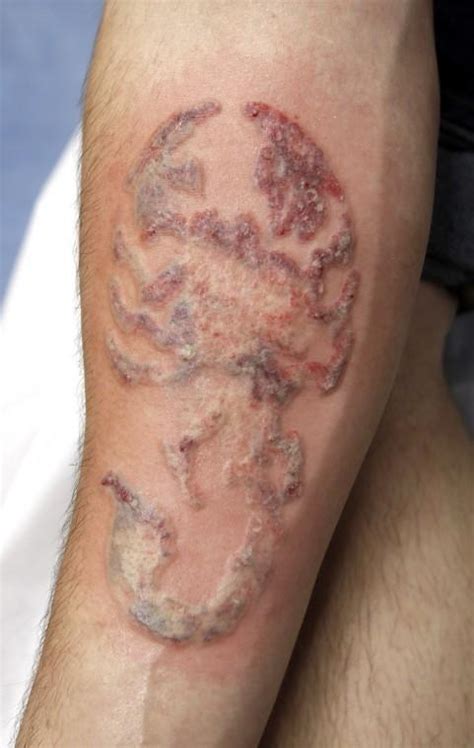 Effortlessly erase regretful ink with Tattoo Removal in Richmond, VA